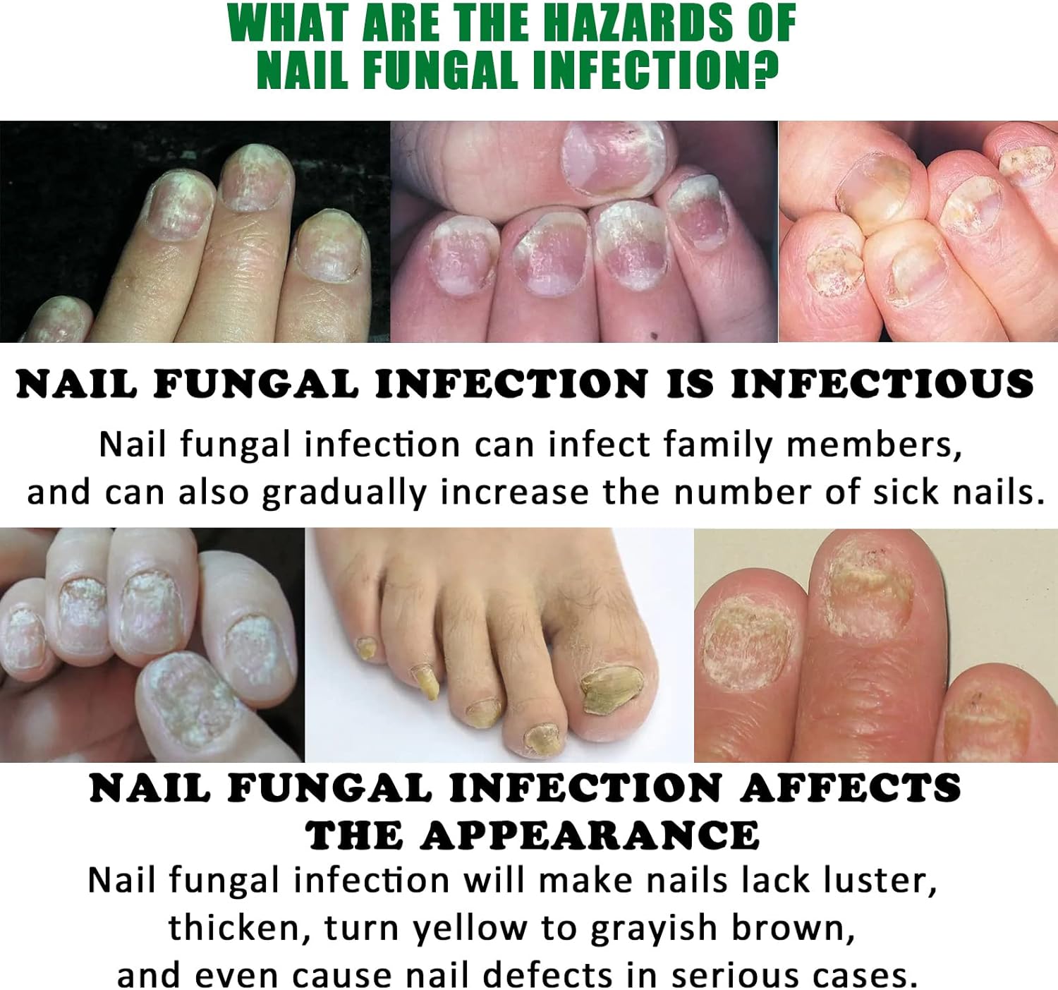 FungiGone™ - Für gesunde, schöne Nägel ohne Pilzbefall