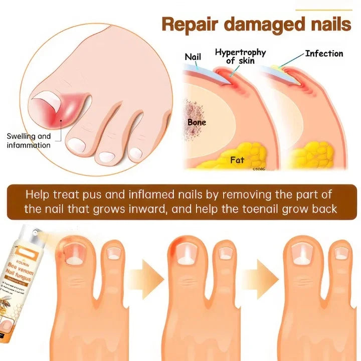 1+1 GRATIS | Venomix™ Schluss mit Nagelpilz in nur 2 Wochen!